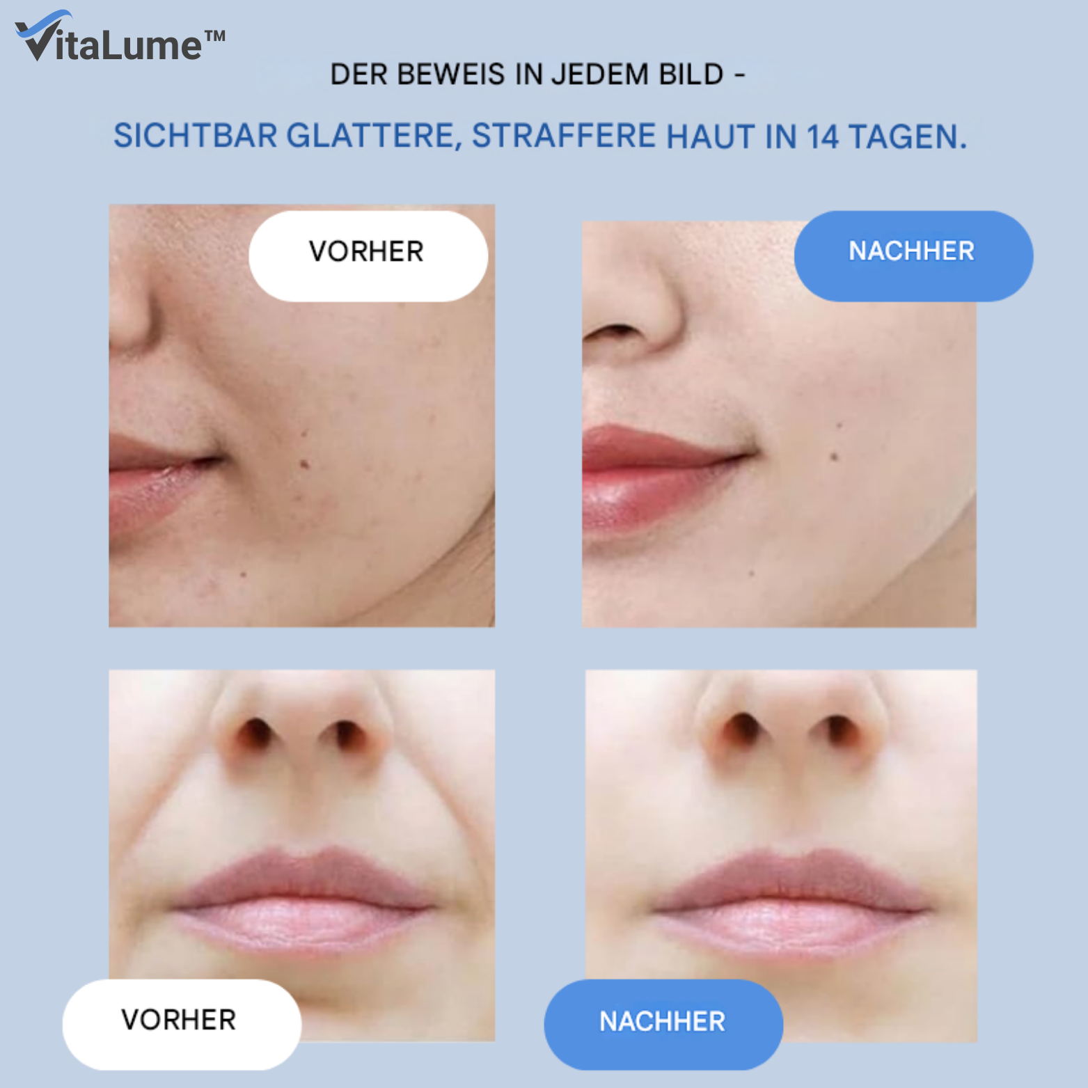 1+1 GRATIS | VitaLume™ Falten Patches – Microkristall und Hyaluronsäure
