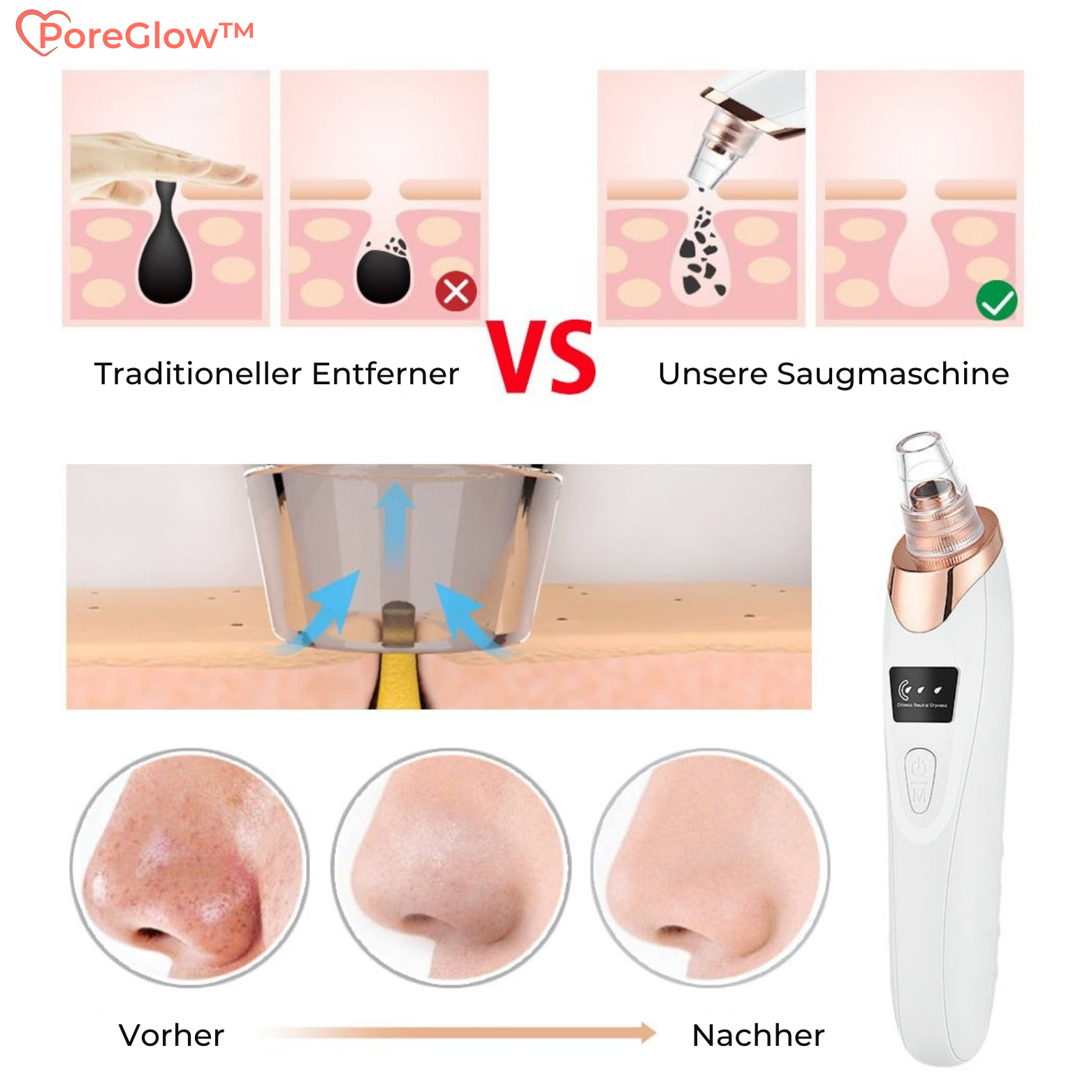 PoreGlow™ Mitesser Entferner Set