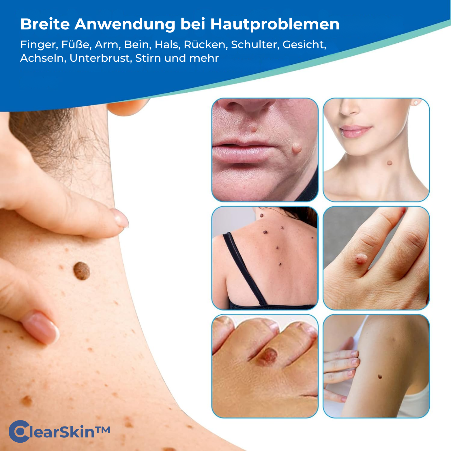 ClearSkin™ Warzenentferner Stift