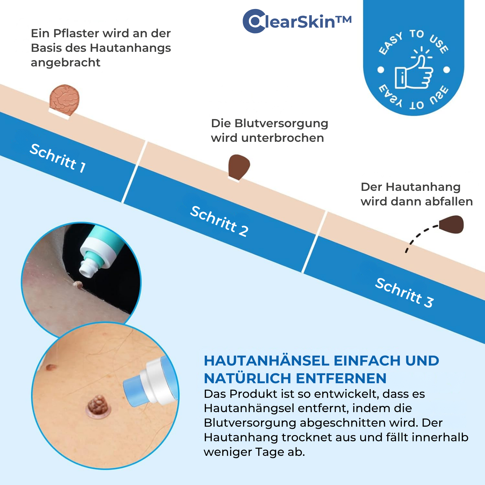 ClearSkin™ Warzenentferner Stift
