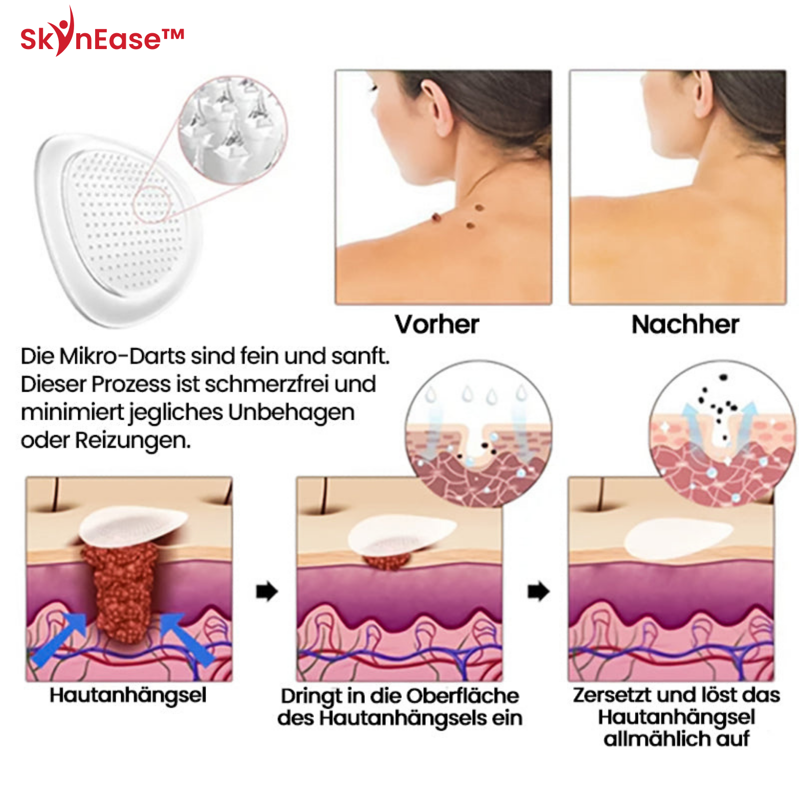 SkinEase™ Microdarts Anti-Falten Patch