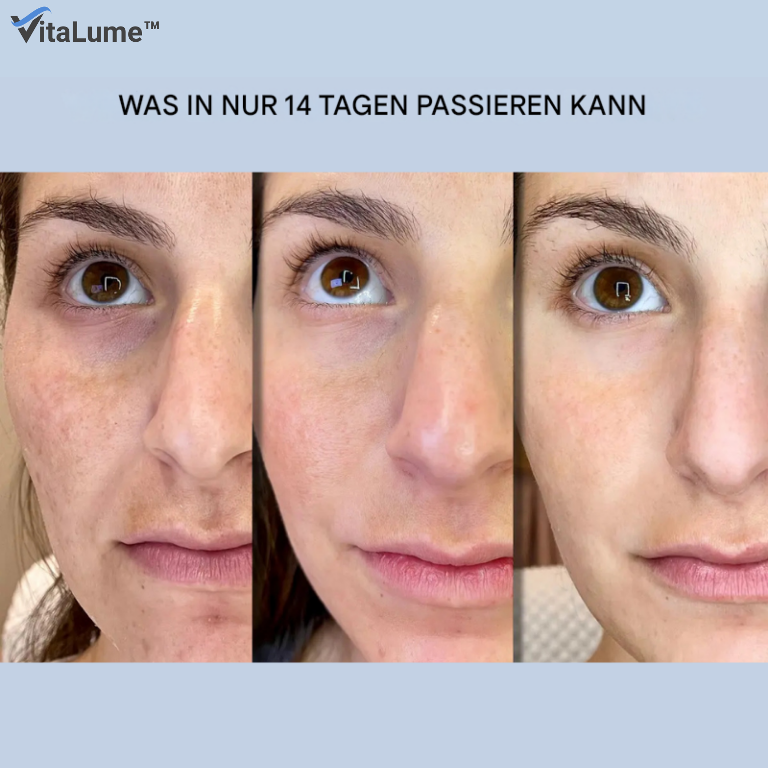 1+1 GRATIS | VitaLume™ Falten Patches – Microkristall und Hyaluronsäure