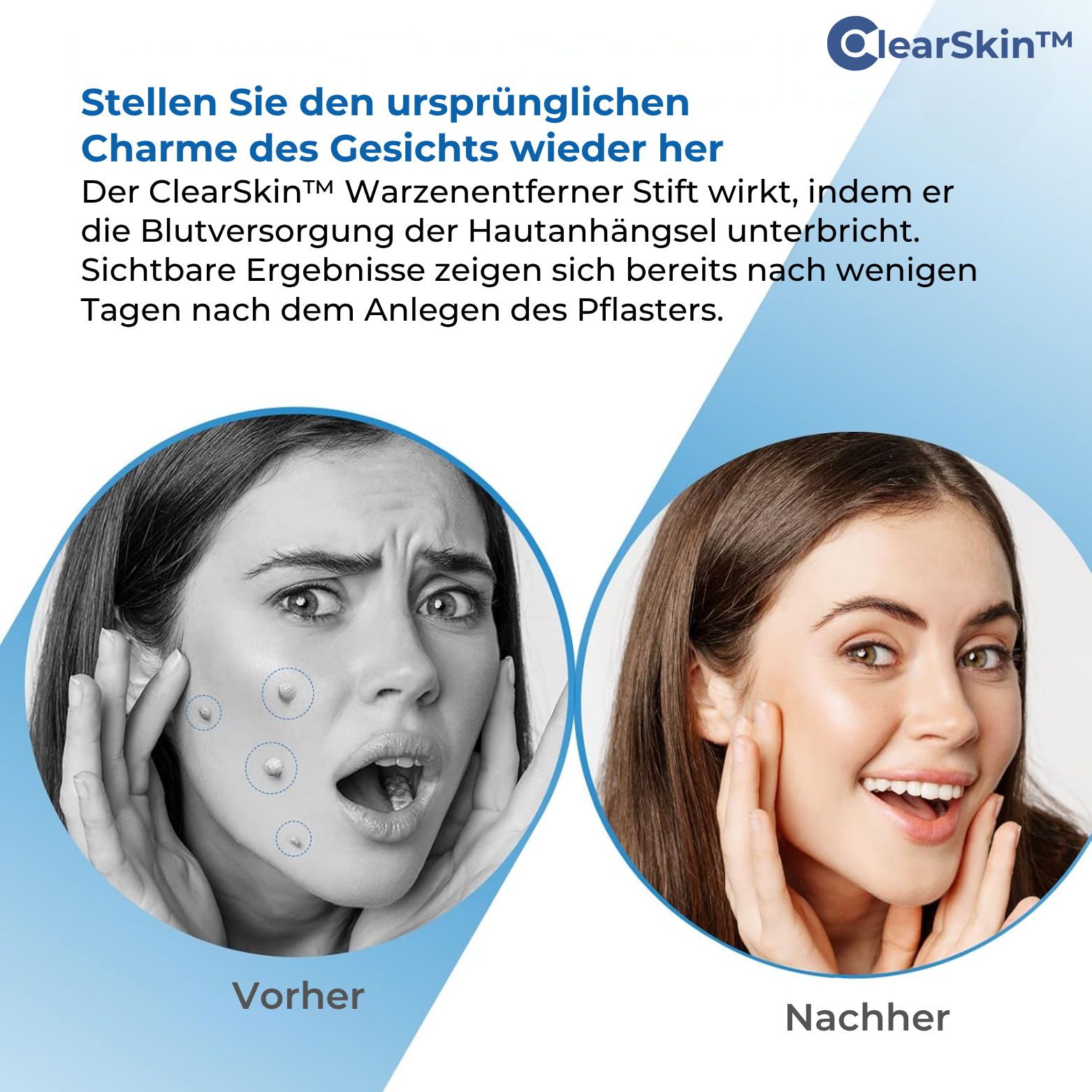 ClearSkin™ Warzenentferner Stift