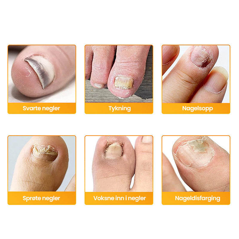 1+1 Gratis | Nalix™ - Wirksame Behandlung von Nagelpilz