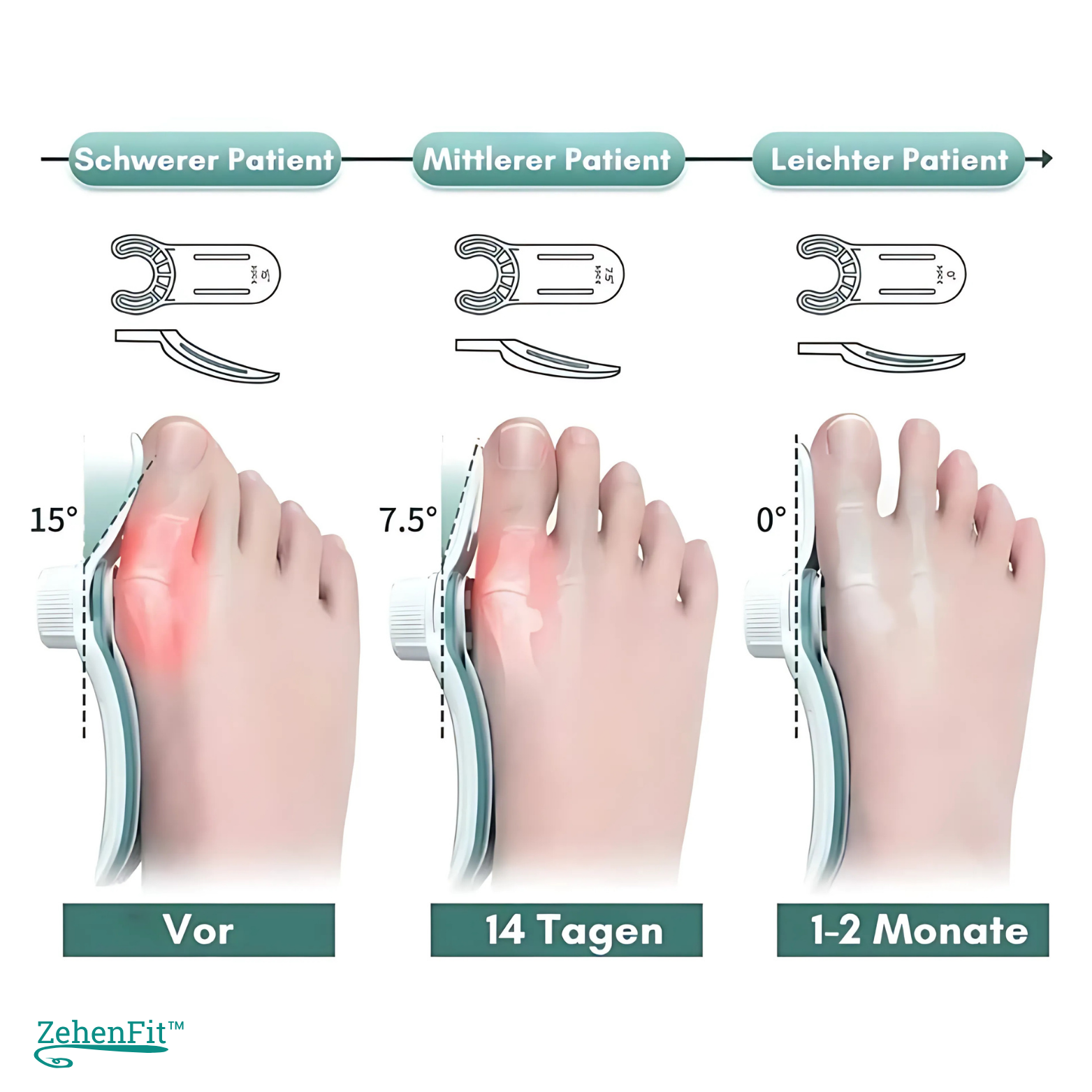 ZehenFit™ Hallux Valgus Korrektur & Zehenspreizer