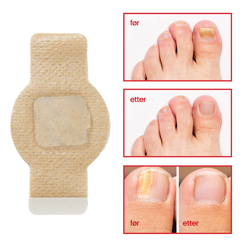 1+1 Gratis | Nalix™ - Wirksame Behandlung von Nagelpilz