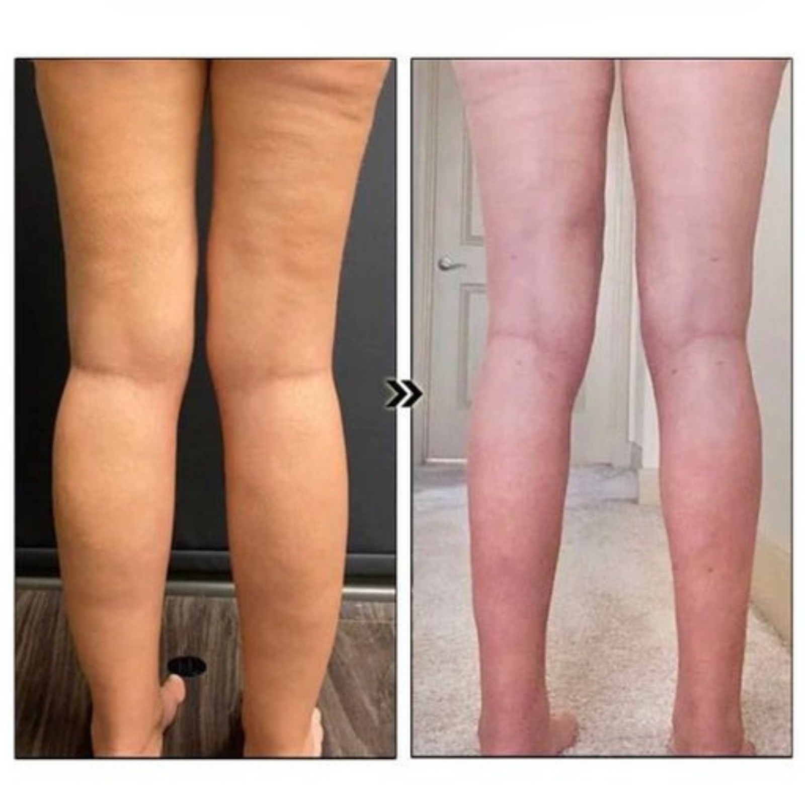 1+1 GRATIS | Acurani™️ Magnetische Therapie-Ohrringe