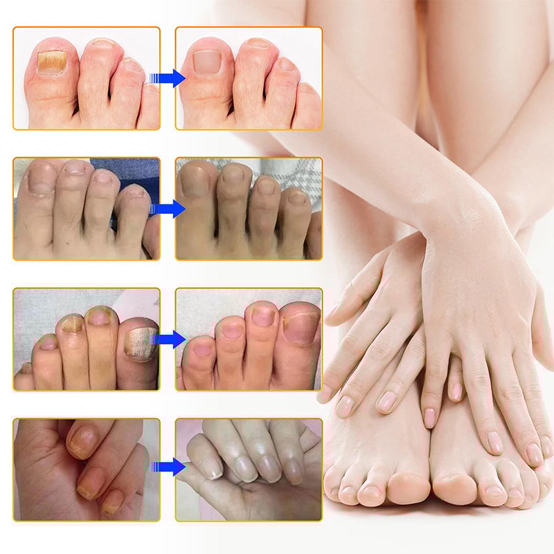 1+1 Gratis | Nalix™ - Wirksame Behandlung von Nagelpilz